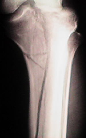 Broken Tibia